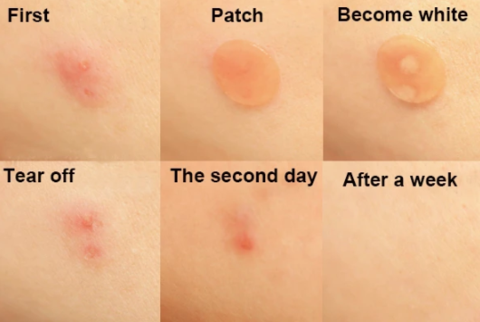 Cosrx, Patch d'acné Pimple Master, 24 patchs
