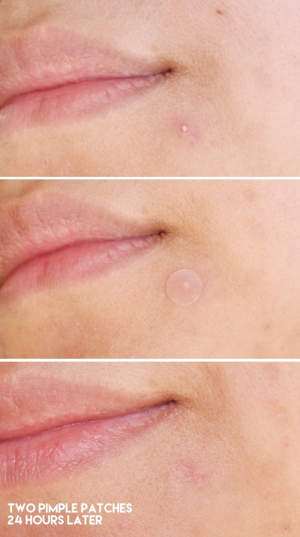 Cosrx, Patch d'acné Pimple Master, 24 patchs